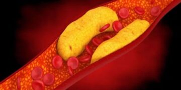 Experts warn those who are lax in controlling cholesterol