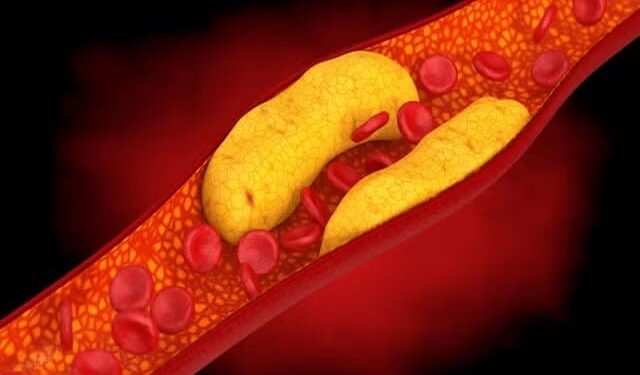 Experts warn those who are lax in controlling cholesterol