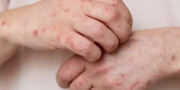 Scientists warn of 'silent epidemic'