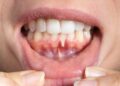 Diabetes May Cause Gum Disease, Research