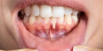 Diabetes May Cause Gum Disease, Research