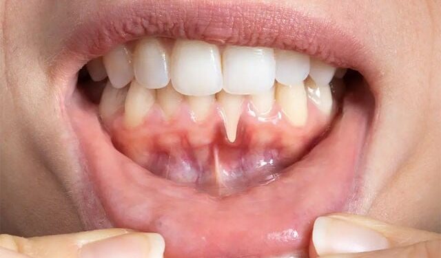 Diabetes May Cause Gum Disease, Research