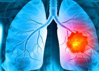 Lung cancer revealed even in non-smokers