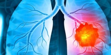 Lung cancer revealed even in non-smokers