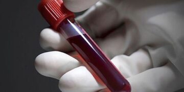 Revealing association of specific blood group with risk of stroke