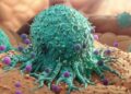 New treatment modality for survival of death from cervical cancer