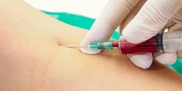 Timing of blood sampling may affect dementia diagnosis results, research