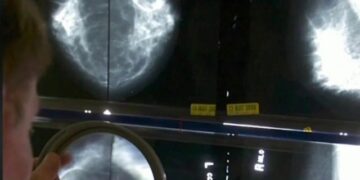 Early puberty increases the risk of breast cancer