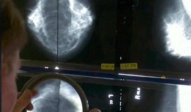 Early puberty increases the risk of breast cancer