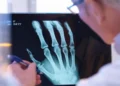 AI technology helps diagnose broken bones
