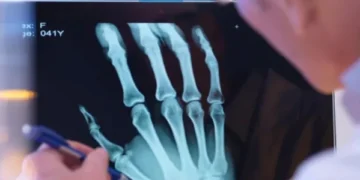 AI technology helps diagnose broken bones