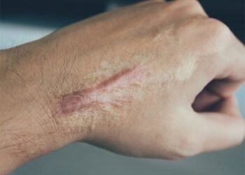 Finding a new way to eliminate scars