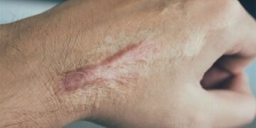 Finding a new way to eliminate scars