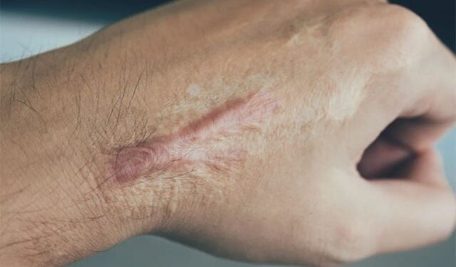 Finding a new way to eliminate scars