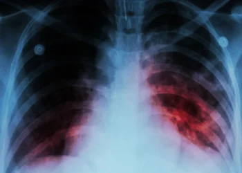 Last year, more than 8 million TB cases were revealed worldwide