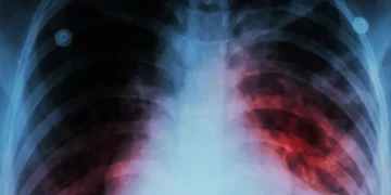 Last year, more than 8 million TB cases were revealed worldwide