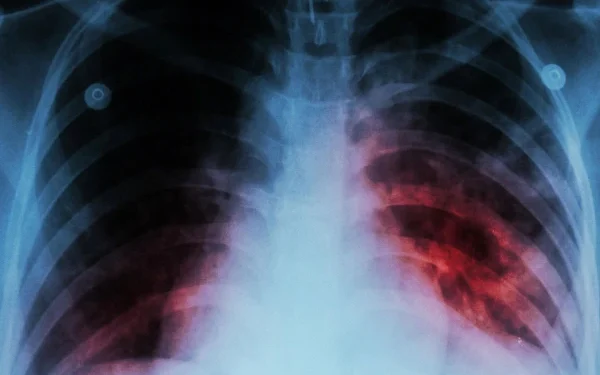 Last year, more than 8 million TB cases were revealed worldwide