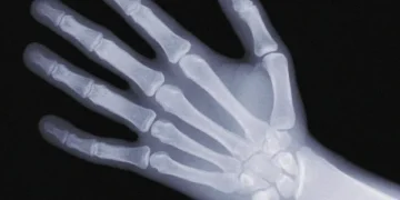 Use of vitamin D during pregnancy is beneficial for children's bones