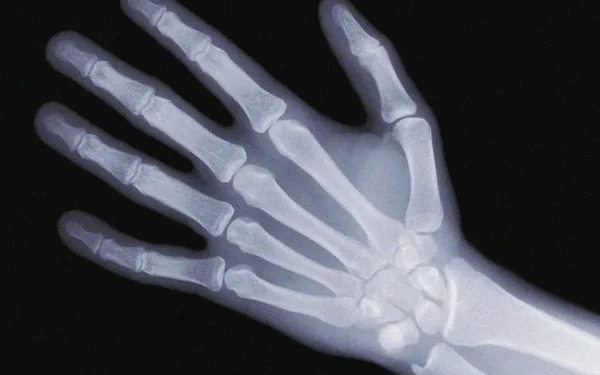 Use of vitamin D during pregnancy is beneficial for children's bones