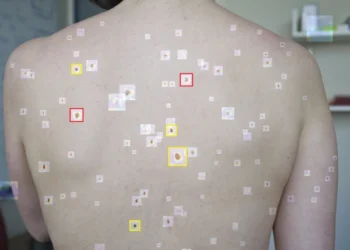 Powerful AI model for skin cancer diagnosis