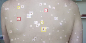 Powerful AI model for skin cancer diagnosis