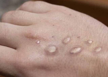 First Monkeypox Case of the Year Reported from Peshawar