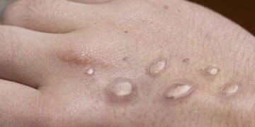 First Monkeypox Case of the Year Reported from Peshawar