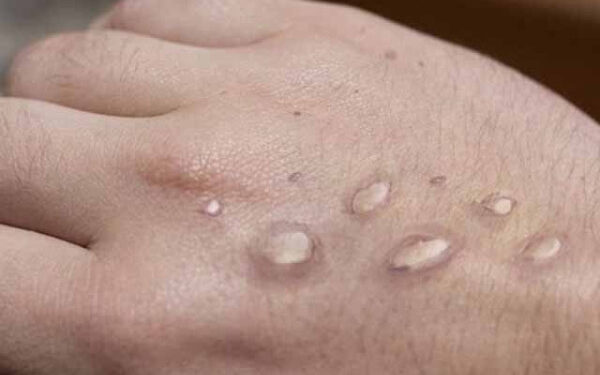 First Monkeypox Case of the Year Reported from Peshawar