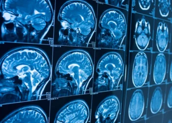 Heart Disease Linked to Brain Shrinkage, Study Finds