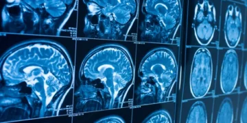 Heart Disease Linked to Brain Shrinkage, Study Finds