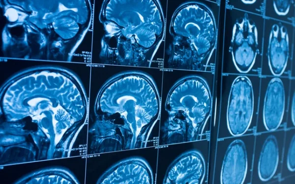 Heart Disease Linked to Brain Shrinkage, Study Finds