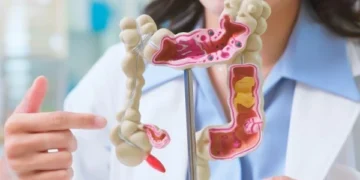 Rising cases of colorectal cancer, concern among experts globally