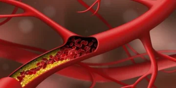 How High Cholesterol Can Increase the Risk of Brain Diseases Like Dementia and Alzheimer’s