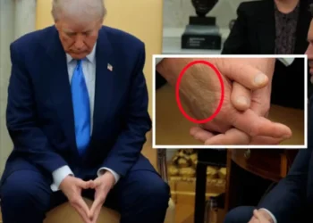 President Trump's Health Update: White House Confirms Chronic Venous Insufficiency Diagnosis Amid Swelling and Bruises