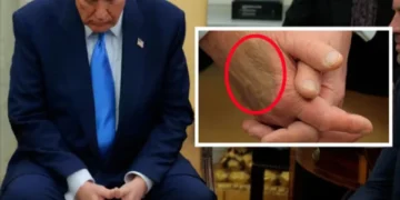 President Trump's Health Update: White House Confirms Chronic Venous Insufficiency Diagnosis Amid Swelling and Bruises