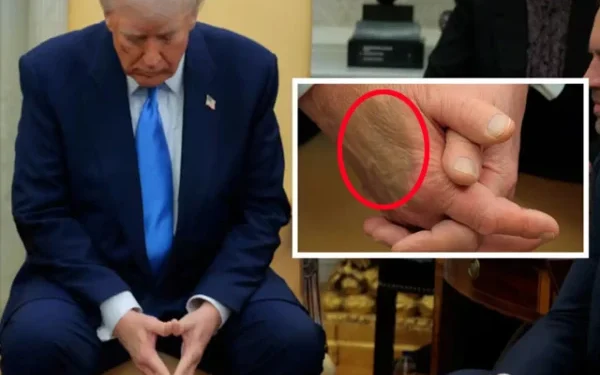 President Trump's Health Update: White House Confirms Chronic Venous Insufficiency Diagnosis Amid Swelling and Bruises